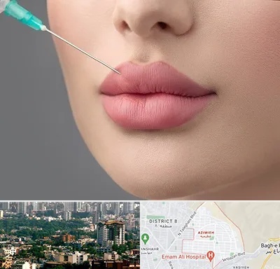 کلینیک ژل لب روسی در عظیمیه کرج 
