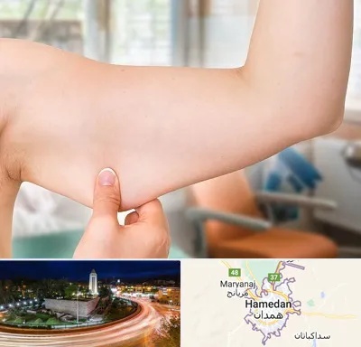 براکیوپلاستی در همدان