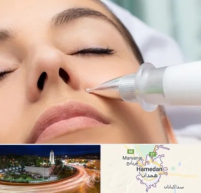 پلاسما جت بینی در همدان