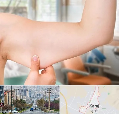 براکیوپلاستی در گوهردشت کرج 