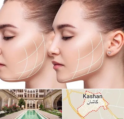 جراحی بوکال فت در کاشان