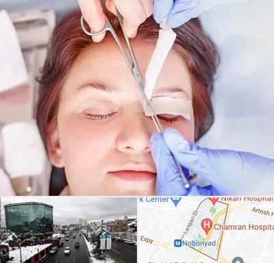 جراحی پلک افتاده در اقدسیه 