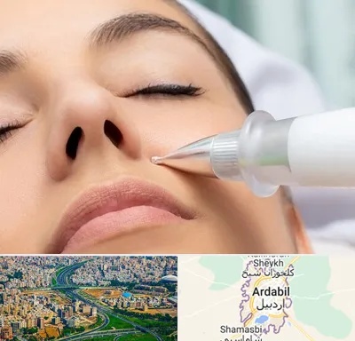 پلاسما جت بینی در اردبیل