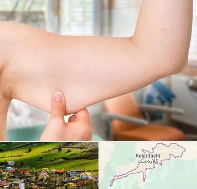 براکیوپلاستی در کلاردشت