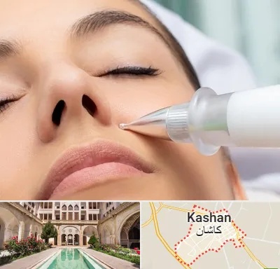 پلاسما جت بینی در کاشان
