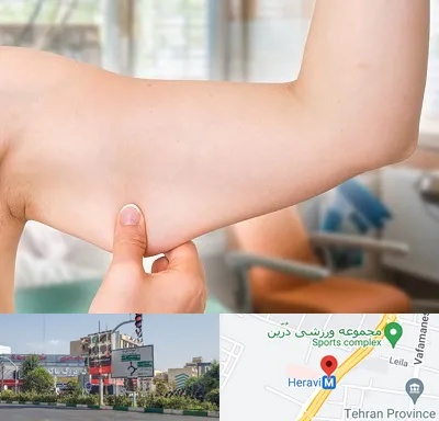 براکیوپلاستی در هروی 