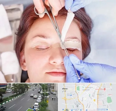 جراحی پلک افتاده در ستارخان 