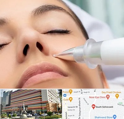 پلاسما جت بینی در سهروردی 