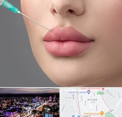 کلینیک ژل لب روسی در گلسار رشت 