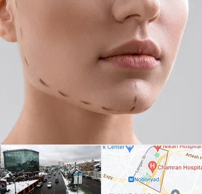 عمل زاویه فک در اقدسیه 