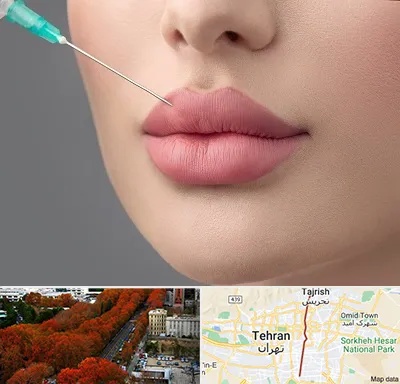 کلینیک ژل لب روسی در ولیعصر 