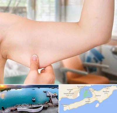 براکیوپلاستی در قشم