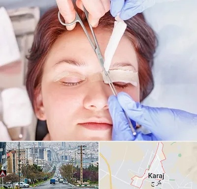 جراحی پلک افتاده در گوهردشت کرج 