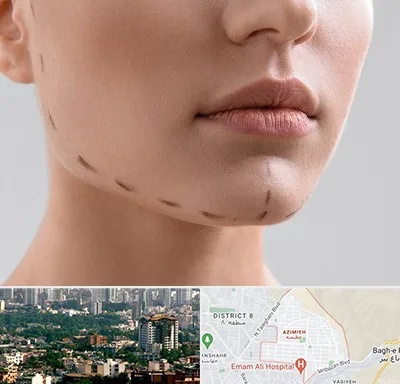 عمل زاویه فک در عظیمیه کرج 