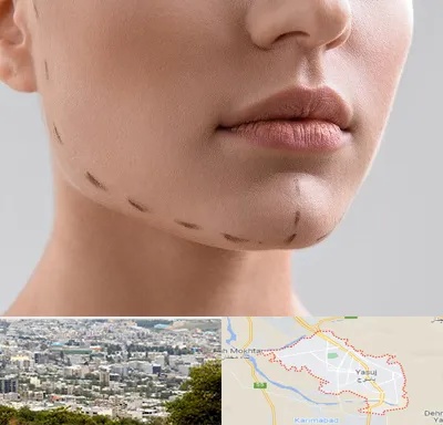 عمل زاویه فک در یاسوج