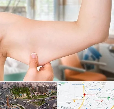 براکیوپلاستی در سبلان 