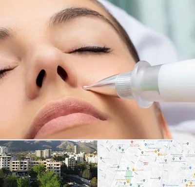 پلاسما جت بینی در دیباجی 
