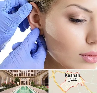 اتوپلاستی در کاشان