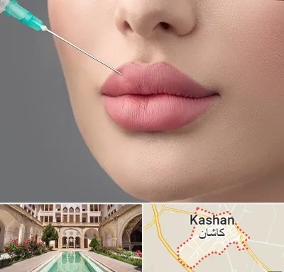 کلینیک ژل لب روسی در کاشان