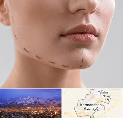 عمل زاویه فک در کرمانشاه