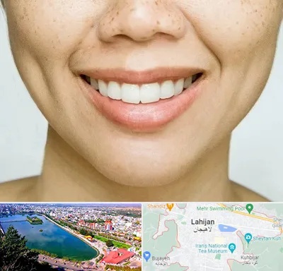 عمل چال گونه در لاهیجان