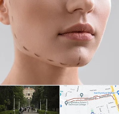 عمل زاویه فک در بلوار معلم رشت 