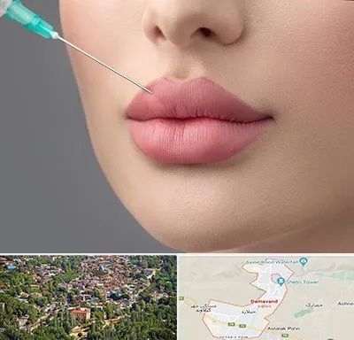 کلینیک ژل لب روسی در دماوند