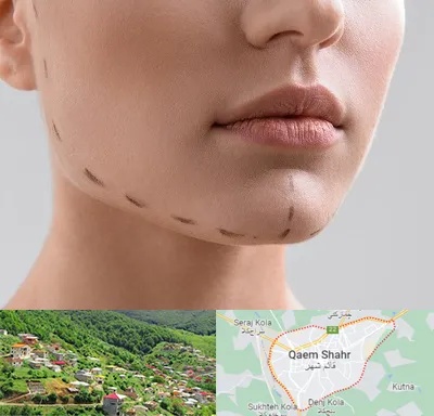 عمل زاویه فک در قائم شهر