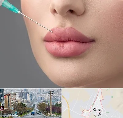کلینیک ژل لب روسی در گوهردشت کرج 