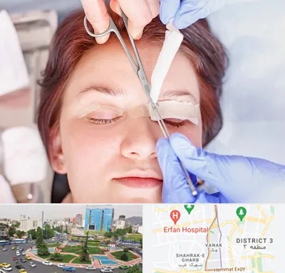 جراحی پلک افتاده در ونک 