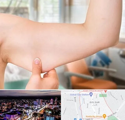 براکیوپلاستی در گلسار رشت 