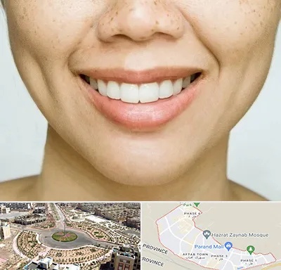 عمل چال گونه در پرند