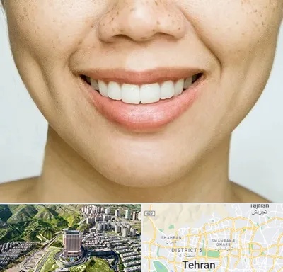 عمل چال گونه در شمال تهران 