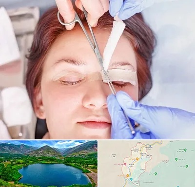 جراحی پلک افتاده در رودبار