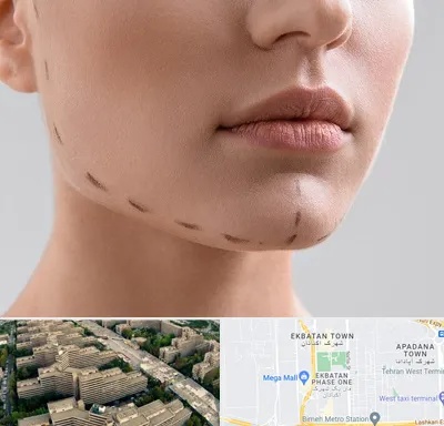 عمل زاویه فک در اکباتان 