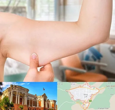 براکیوپلاستی در خوی