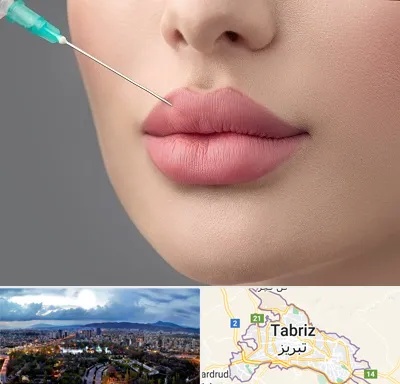 کلینیک ژل لب روسی در تبریز