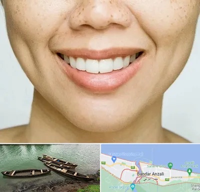 عمل چال گونه در بندر انزلی