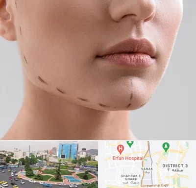 عمل زاویه فک در ونک 