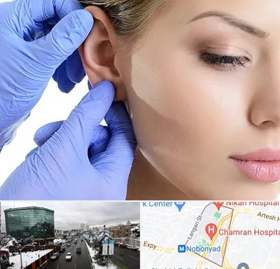 اتوپلاستی در اقدسیه 