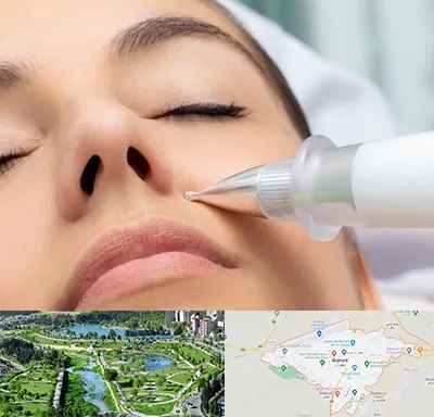 پلاسما جت بینی در بجنورد