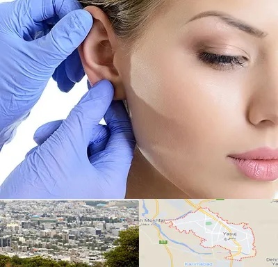 اتوپلاستی در یاسوج