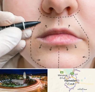عمل سانترال لب در همدان