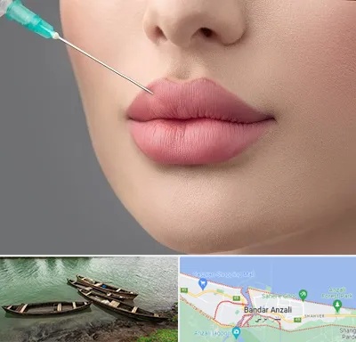 کلینیک ژل لب روسی در بندر انزلی