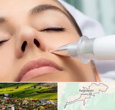 پلاسما جت بینی در کلاردشت