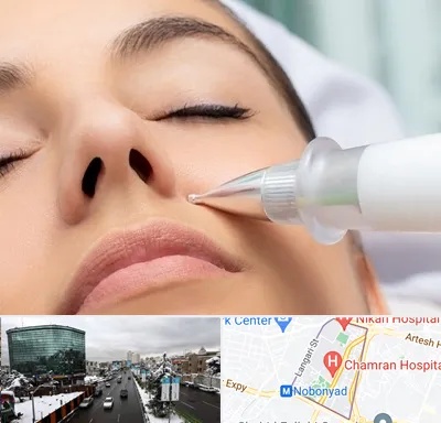 پلاسما جت بینی در اقدسیه 