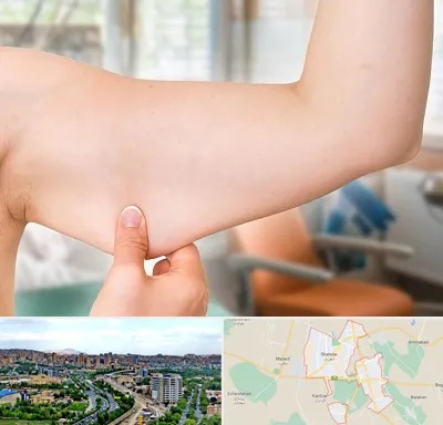 براکیوپلاستی در شهریار