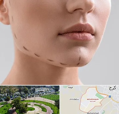 عمل زاویه فک در مهرشهر کرج 
