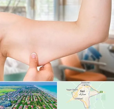 براکیوپلاستی در ساری