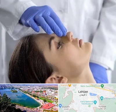 عمل بینی عروسکی در لاهیجان